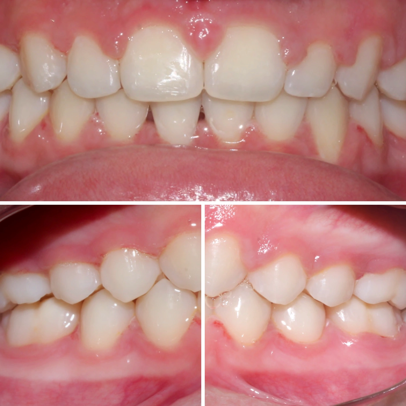 After orthodontic treatment, Smile Gallery case 1