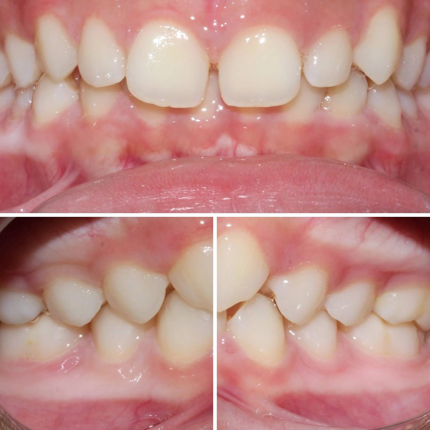 Before orthodontic treatment, Smile Gallery case 1