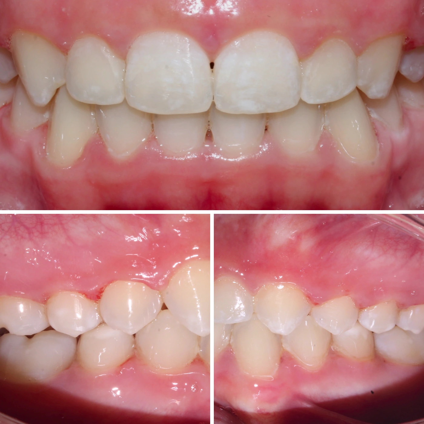 After orthodontic treatment, Smile Gallery case 2