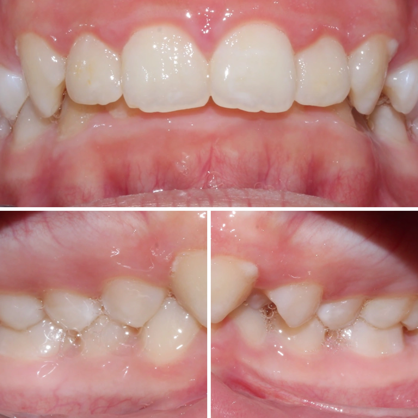Before orthodontic treatment, Smile Gallery case 2