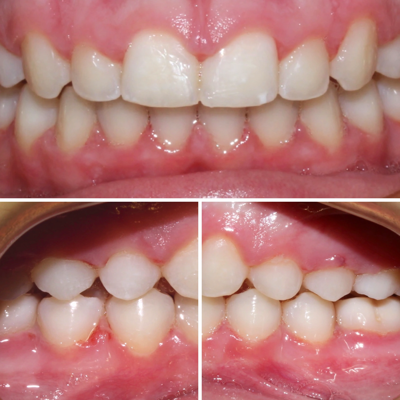 After orthodontic treatment, Smile Gallery case 3