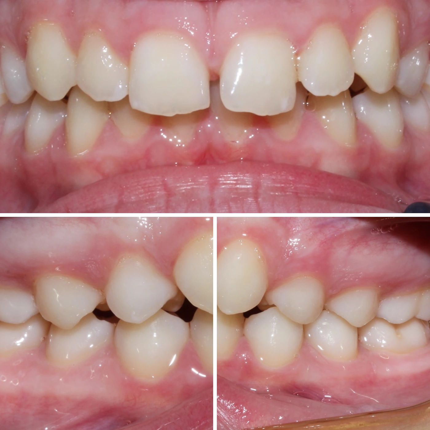 Before orthodontic treatment, Smile Gallery case 3
