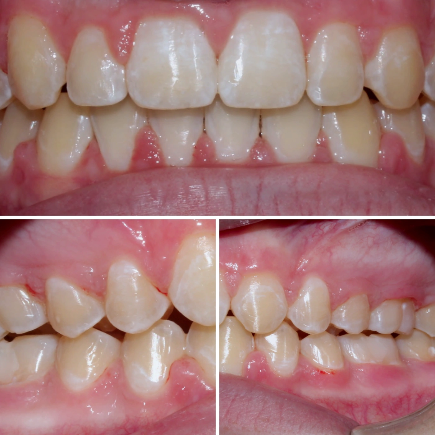 After orthodontic treatment, Smile Gallery case 4