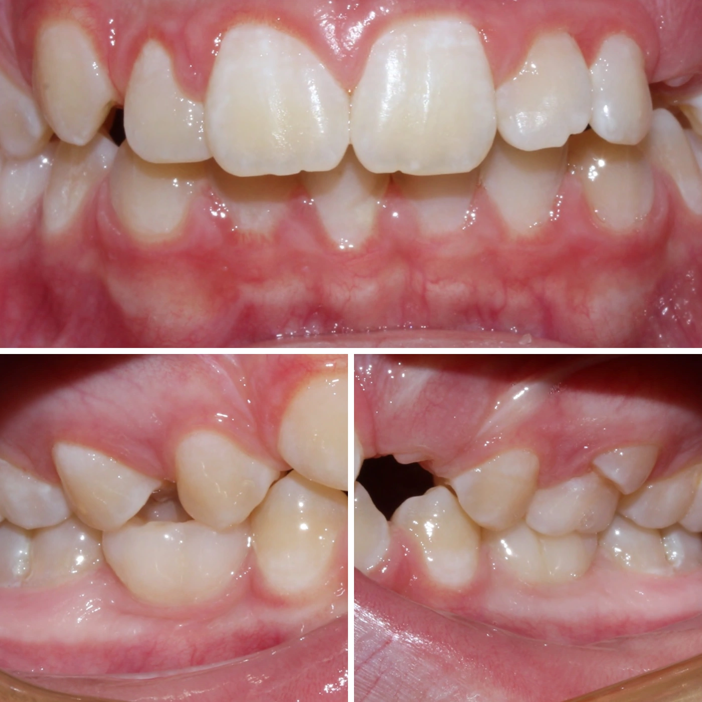 Before orthodontic treatment, Smile Gallery case 4