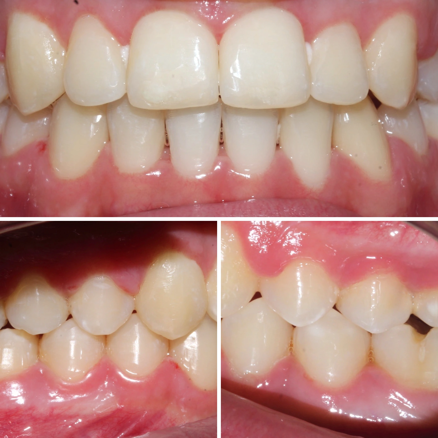 After orthodontic treatment, Smile Gallery case 5