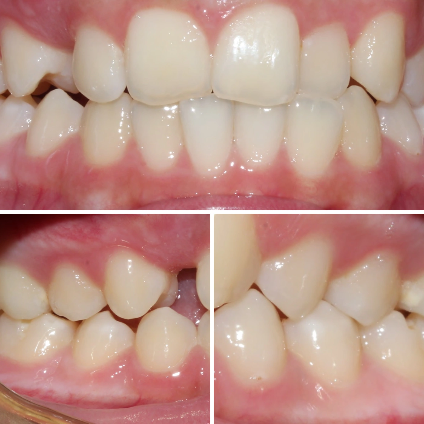Before orthodontic treatment, Smile Gallery case 5