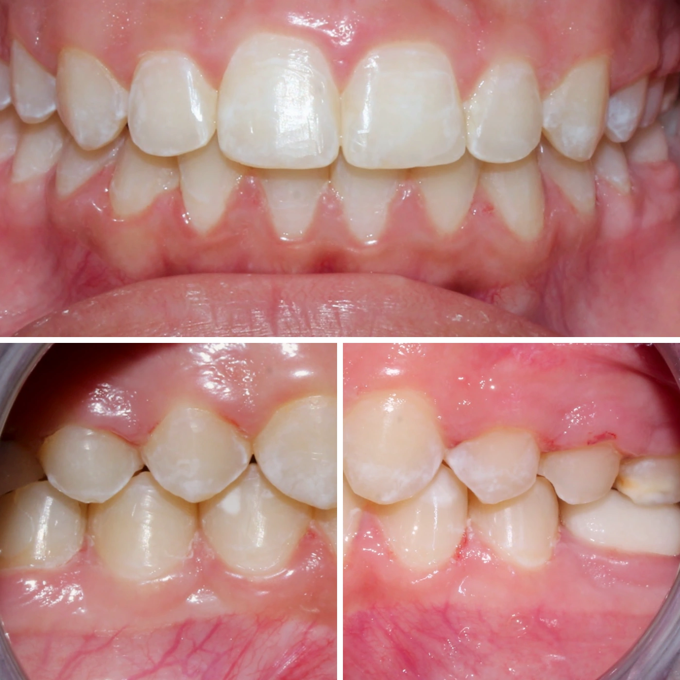 After orthodontic treatment, Smile Gallery case 6