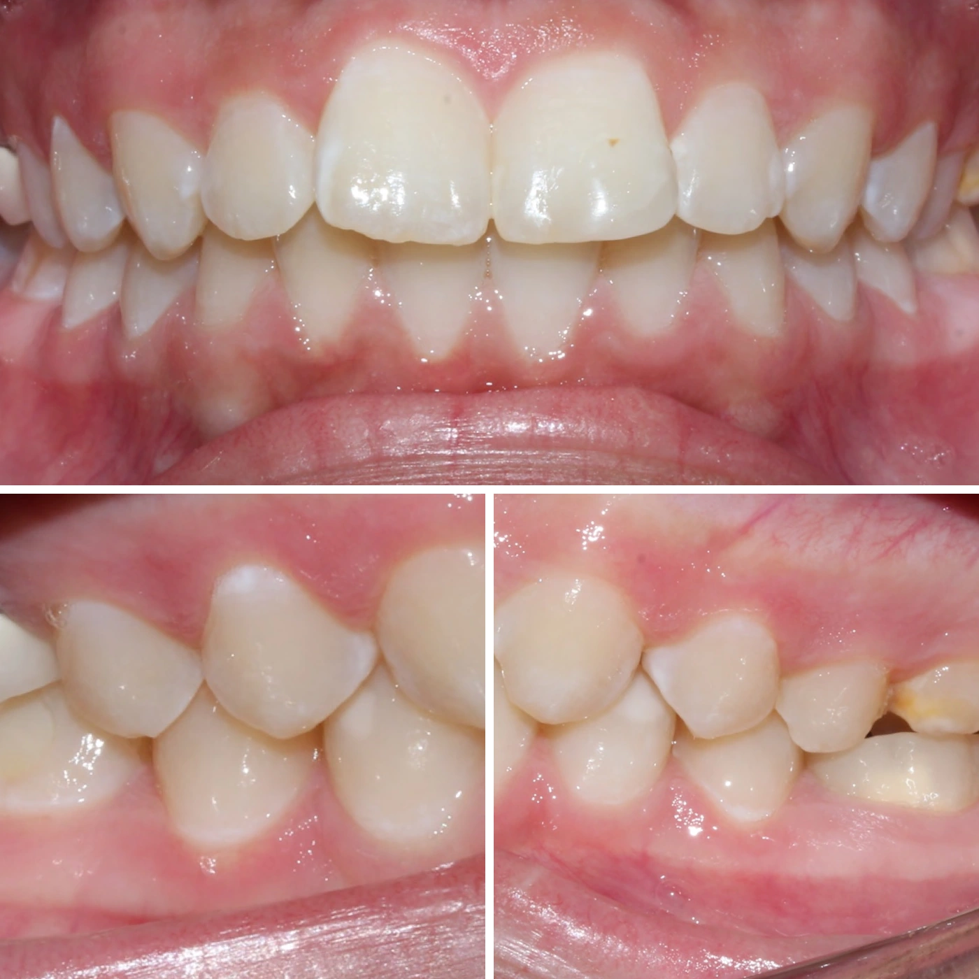 Before orthodontic treatment, Smile Gallery case 6
