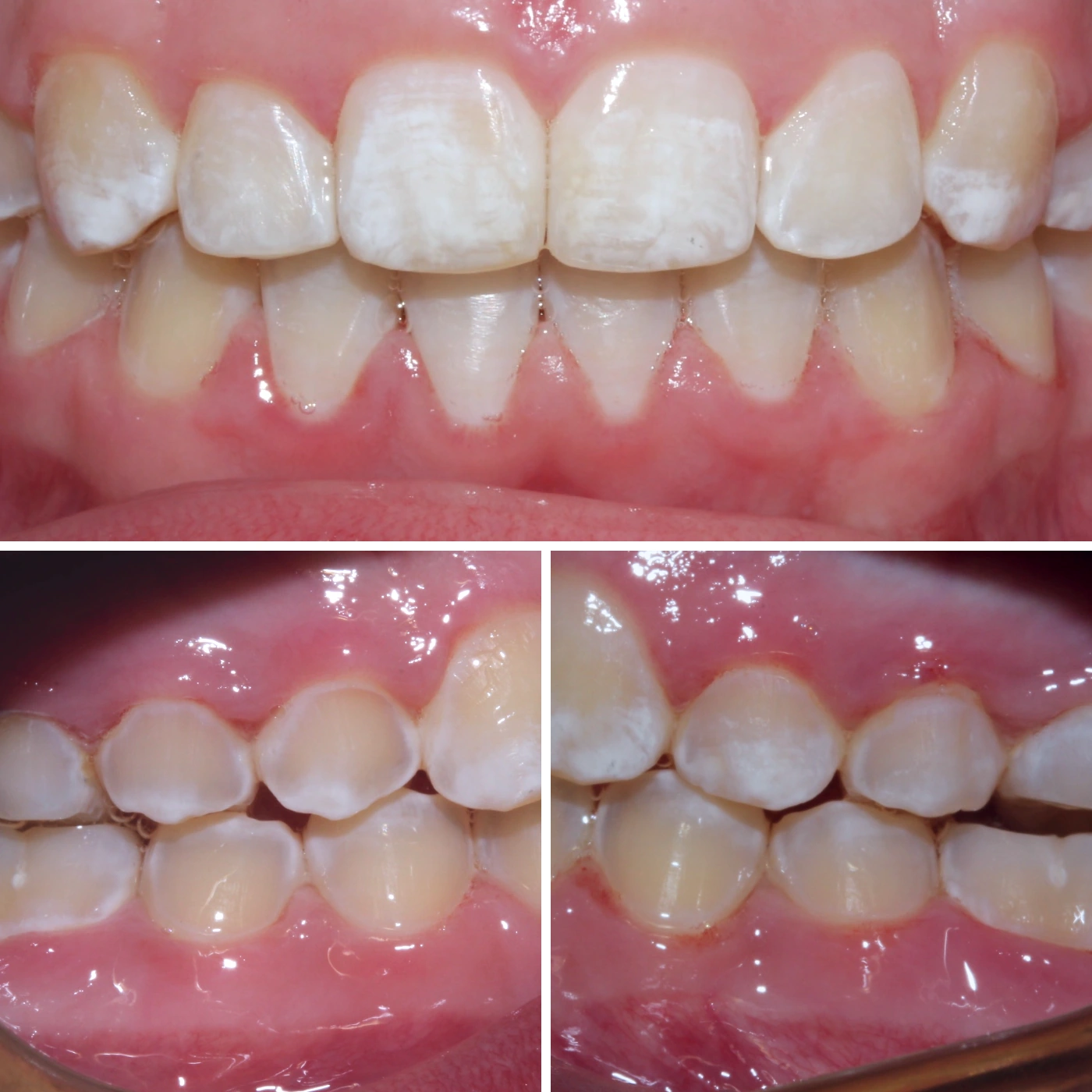 After orthodontic treatment, Smile Gallery case 7