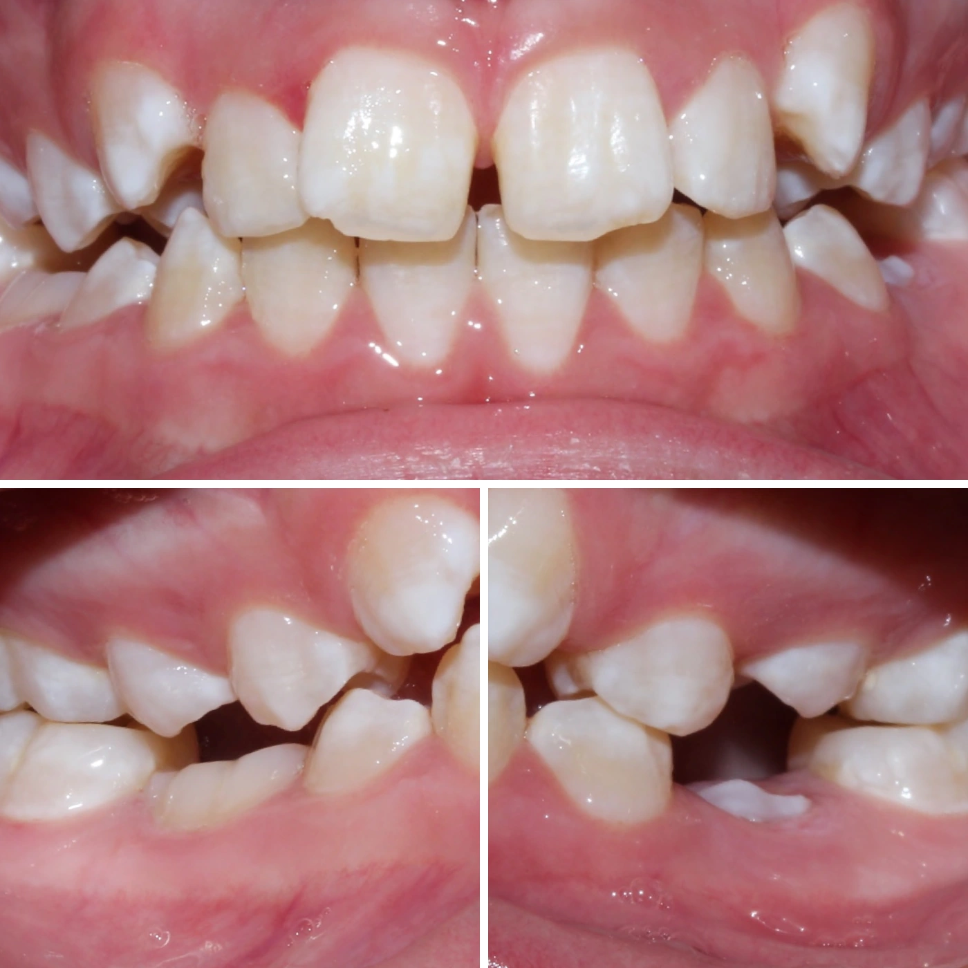 Before orthodontic treatment, Smile Gallery case 7