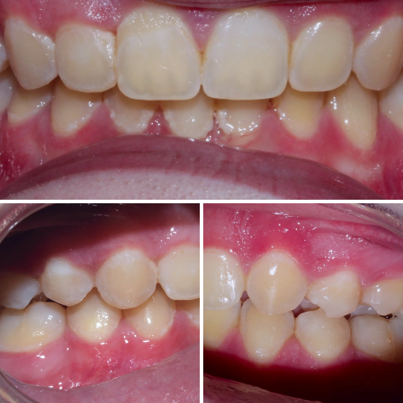 After orthodontic treatment, Smile Gallery case 8
