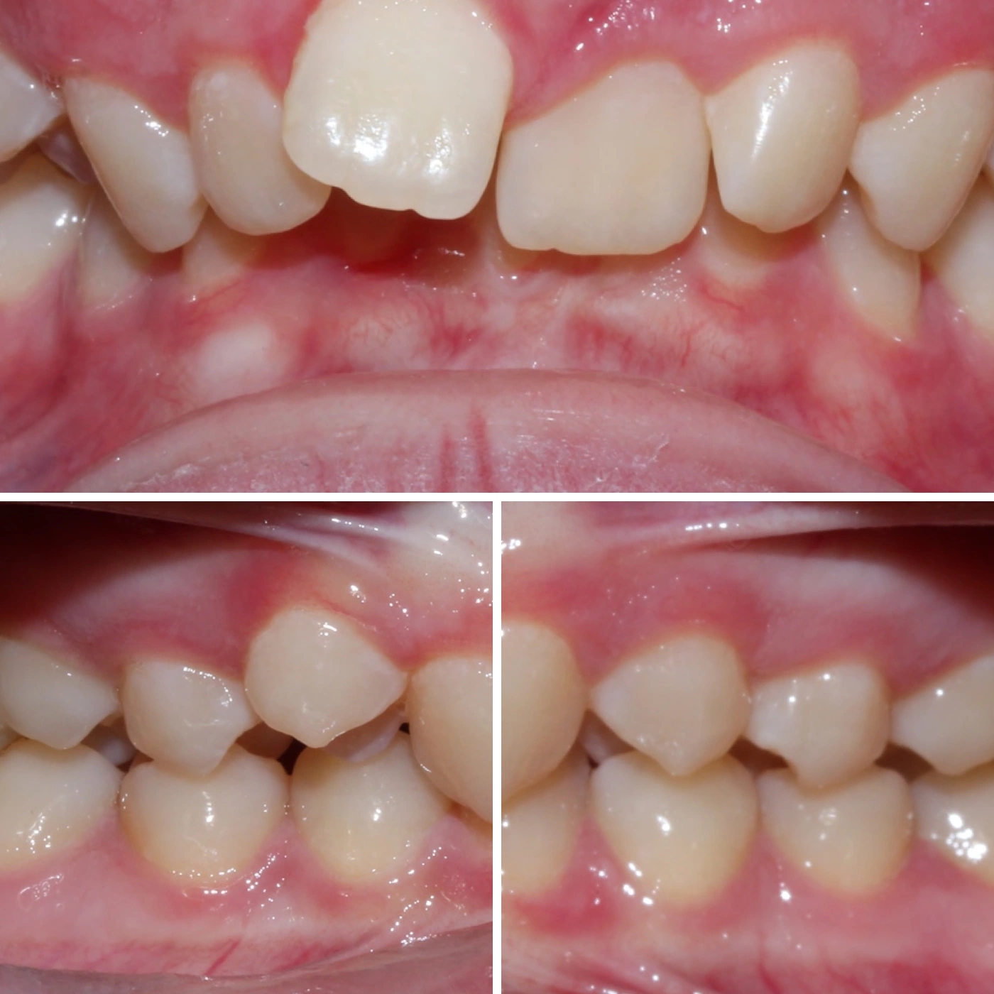 Before orthodontic treatment, Smile Gallery case 8