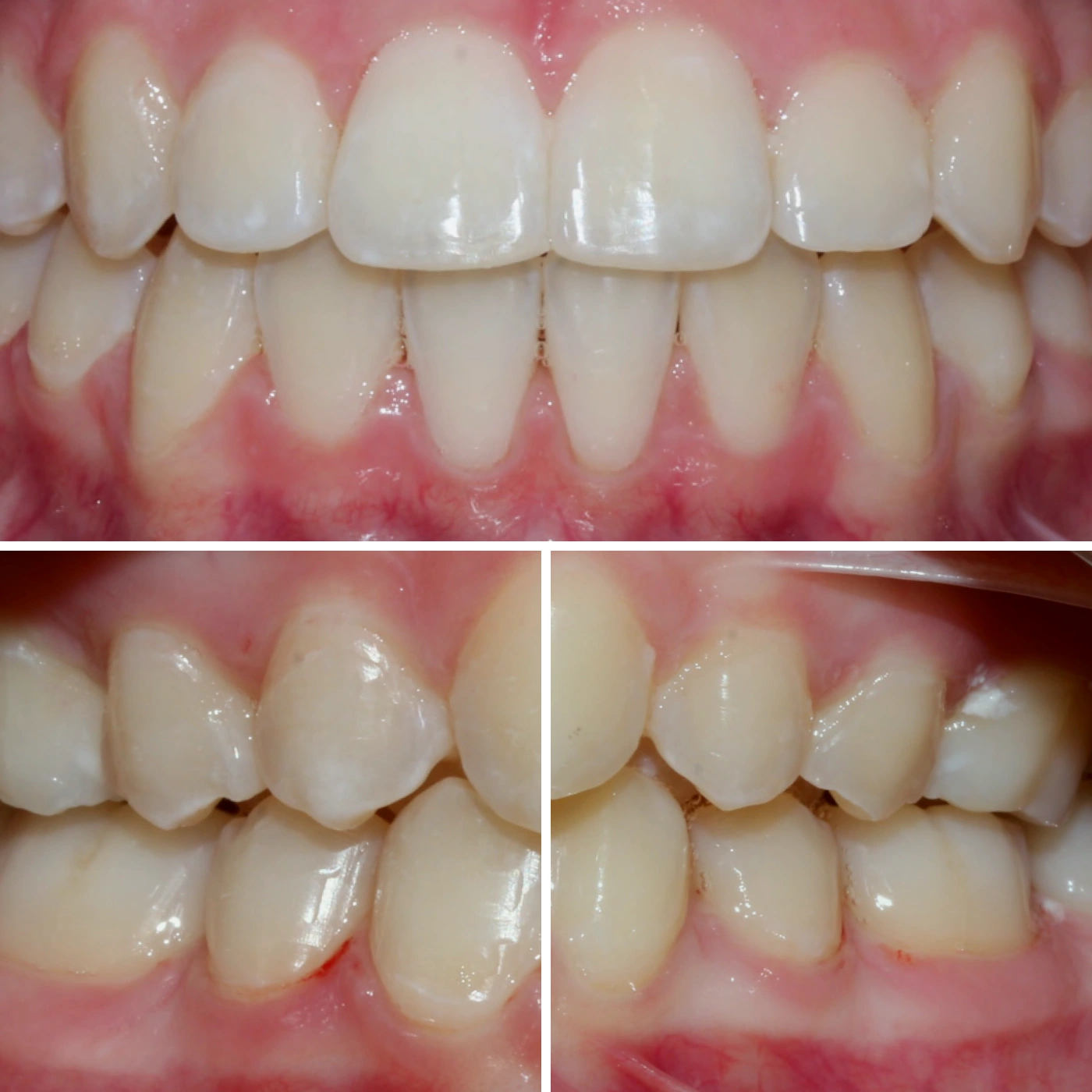 After orthodontic treatment, Smile Gallery case 9