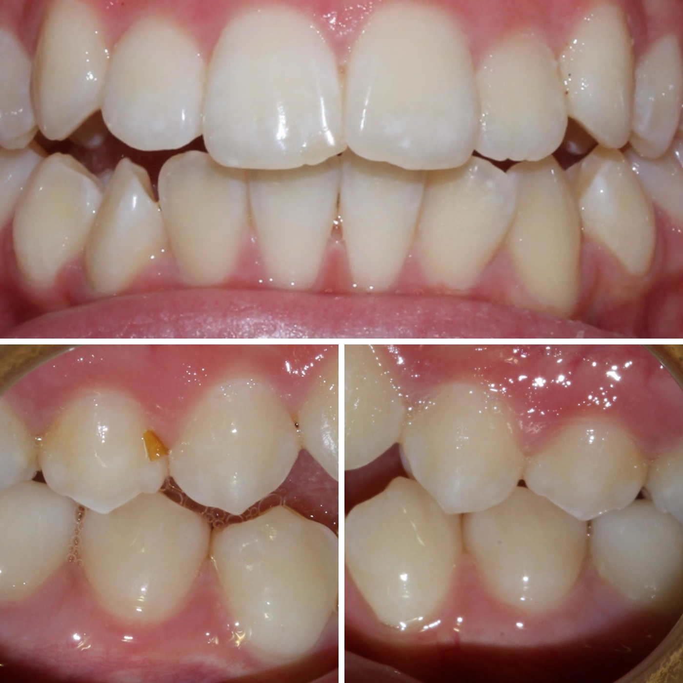 Before orthodontic treatment, Smile Gallery case 9