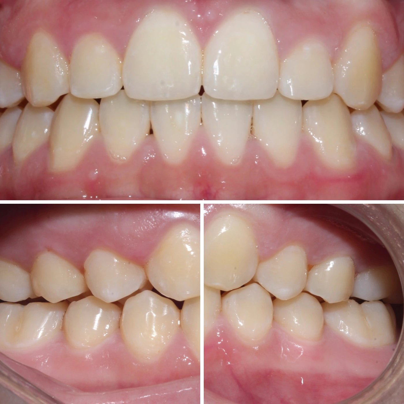 After orthodontic treatment, Smile Gallery case 10
