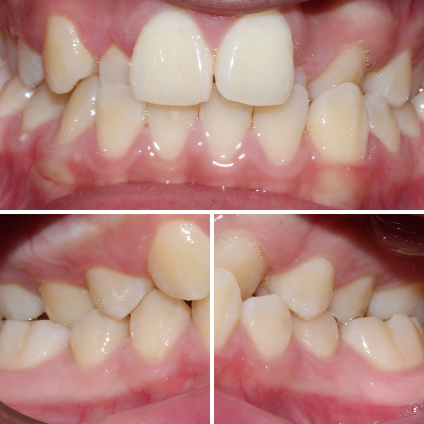 Before orthodontic treatment, Smile Gallery case 10