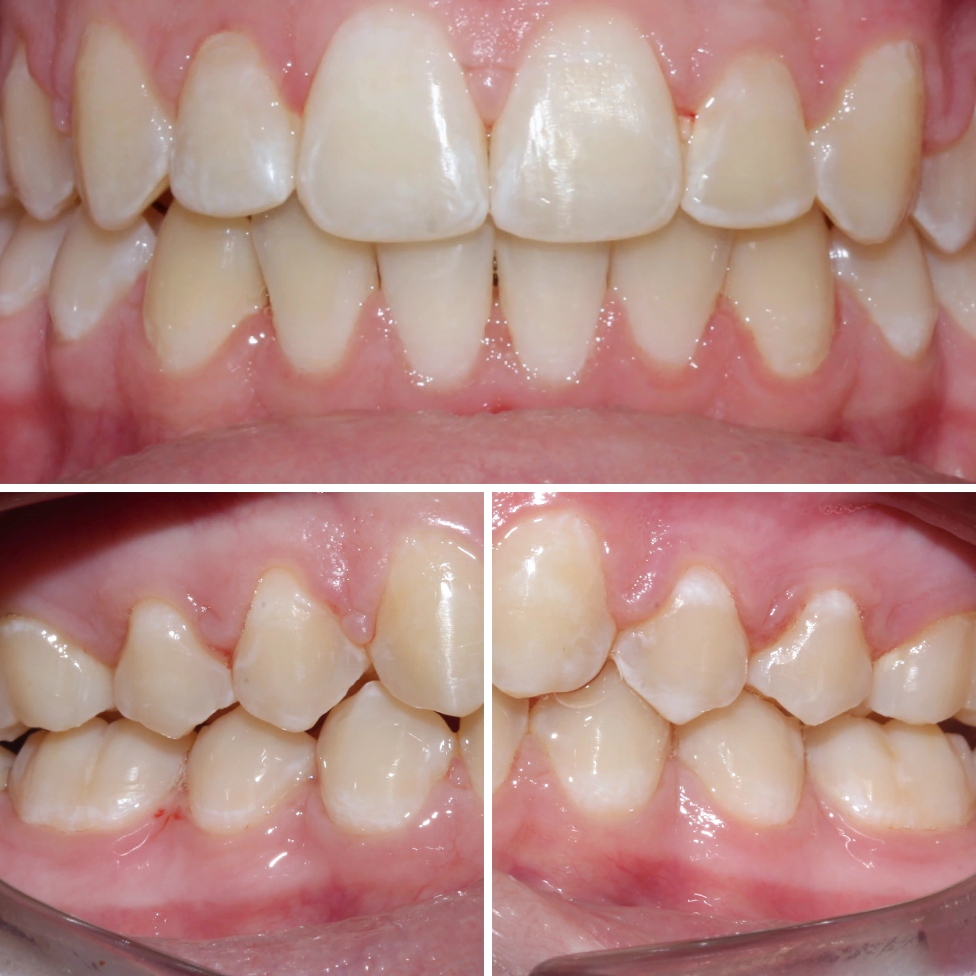 After orthodontic treatment, Smile Gallery case 11