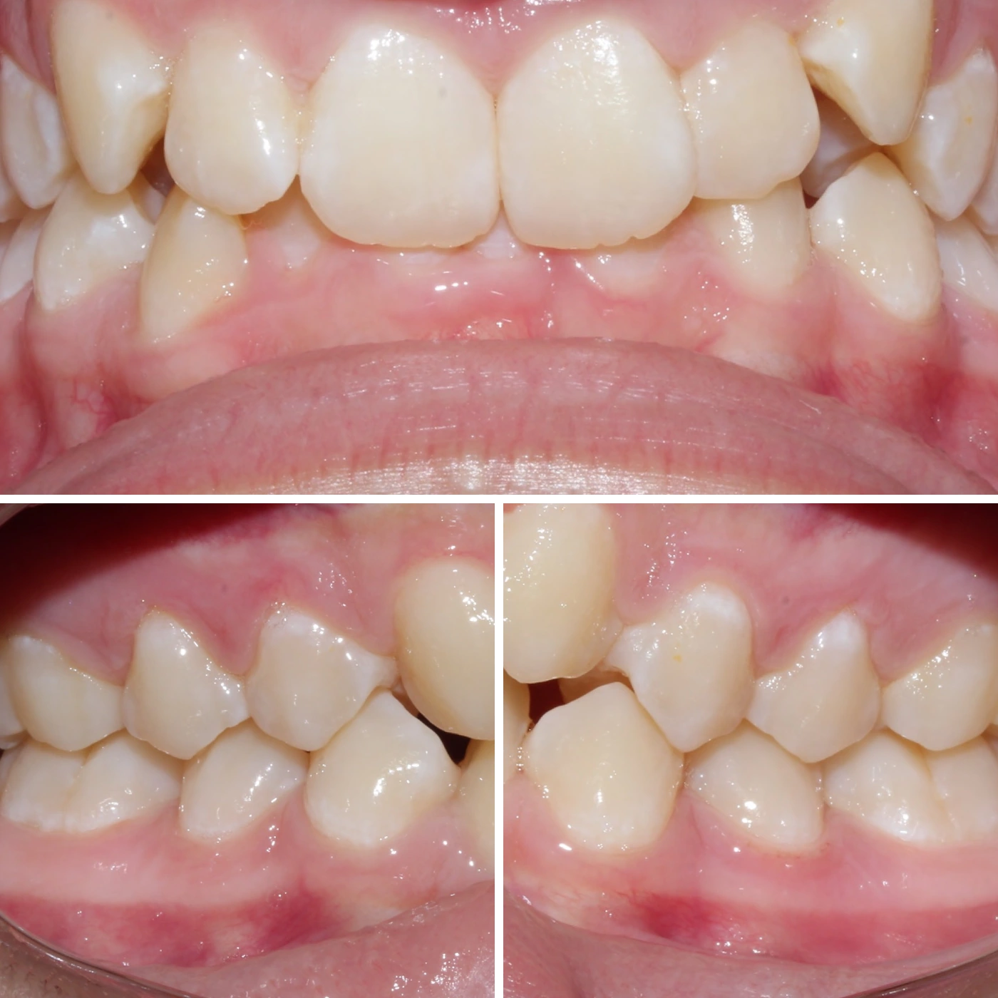 Before orthodontic treatment, Smile Gallery case 11