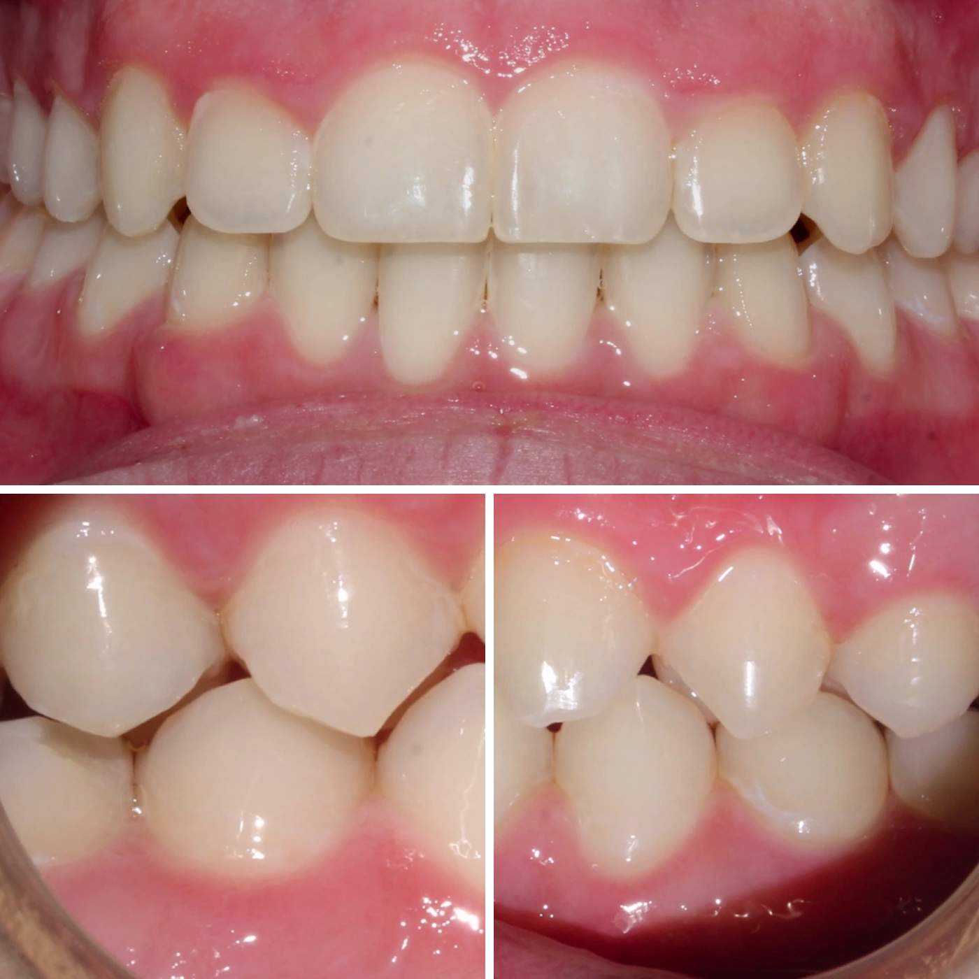 After orthodontic treatment, Smile Gallery case 12
