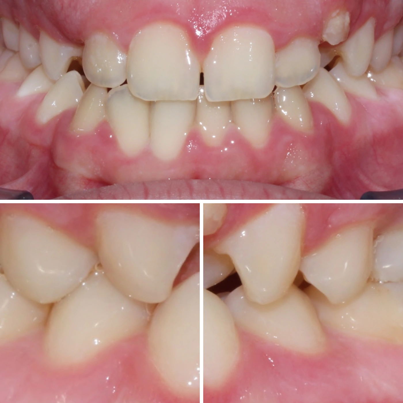 Before orthodontic treatment, Smile Gallery case 12