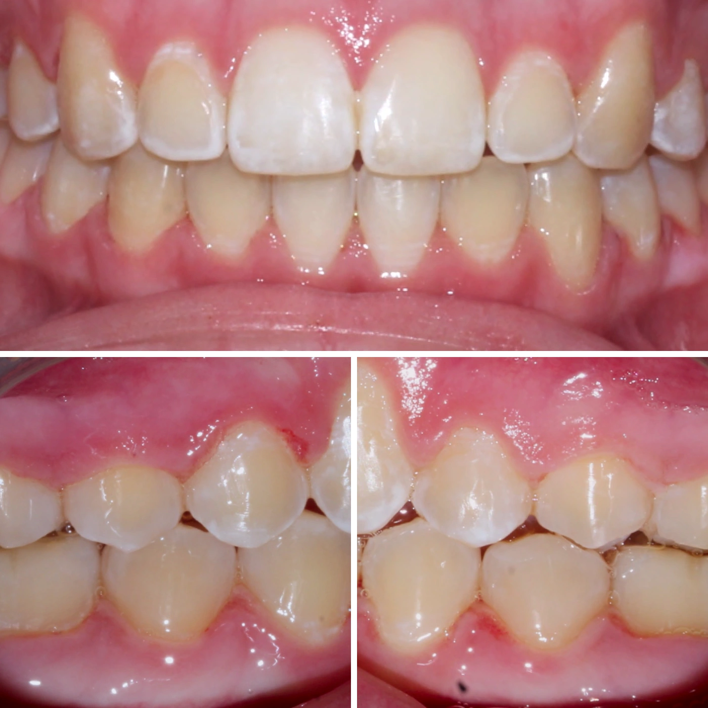After orthodontic treatment, Smile Gallery case 13