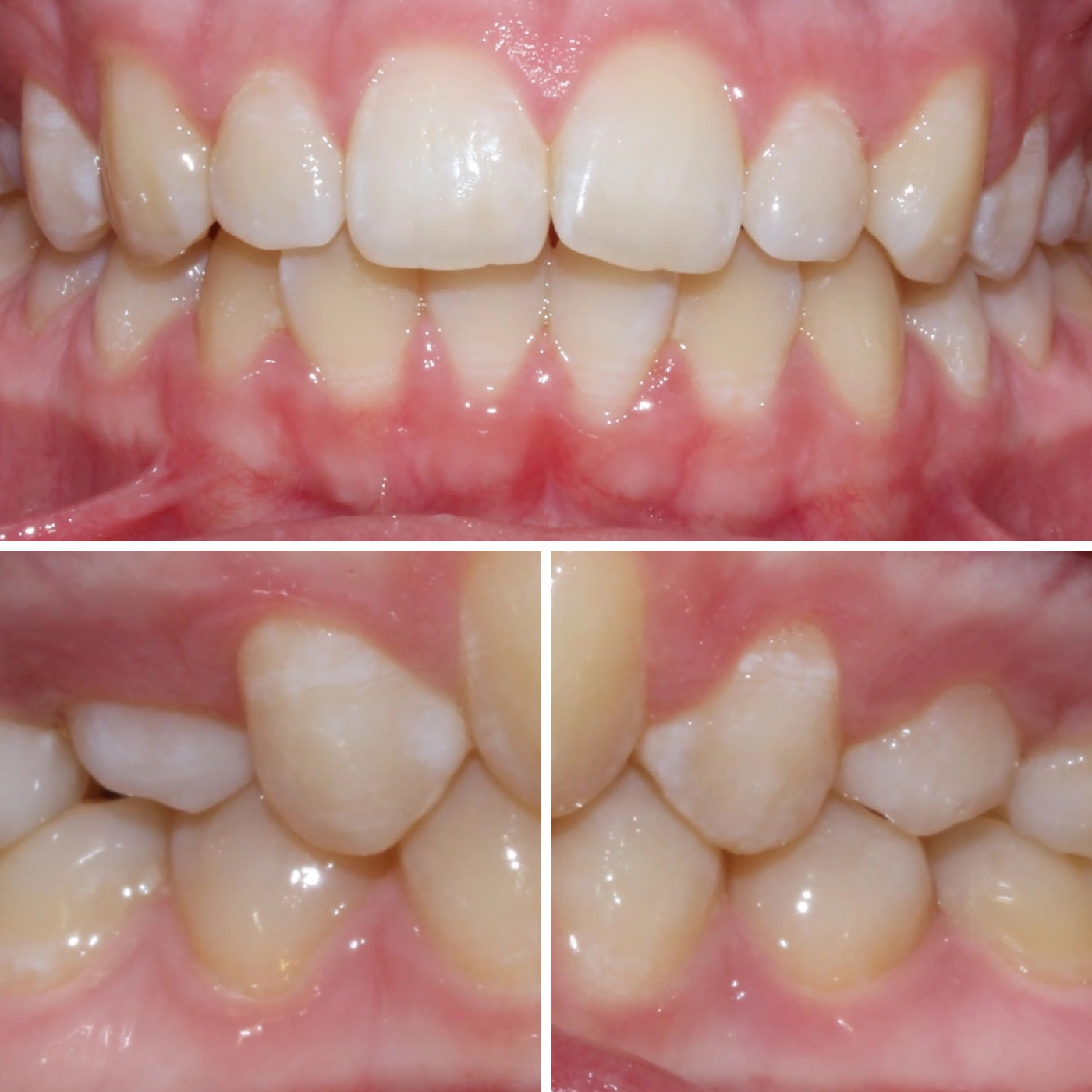 Before orthodontic treatment, Smile Gallery case 13