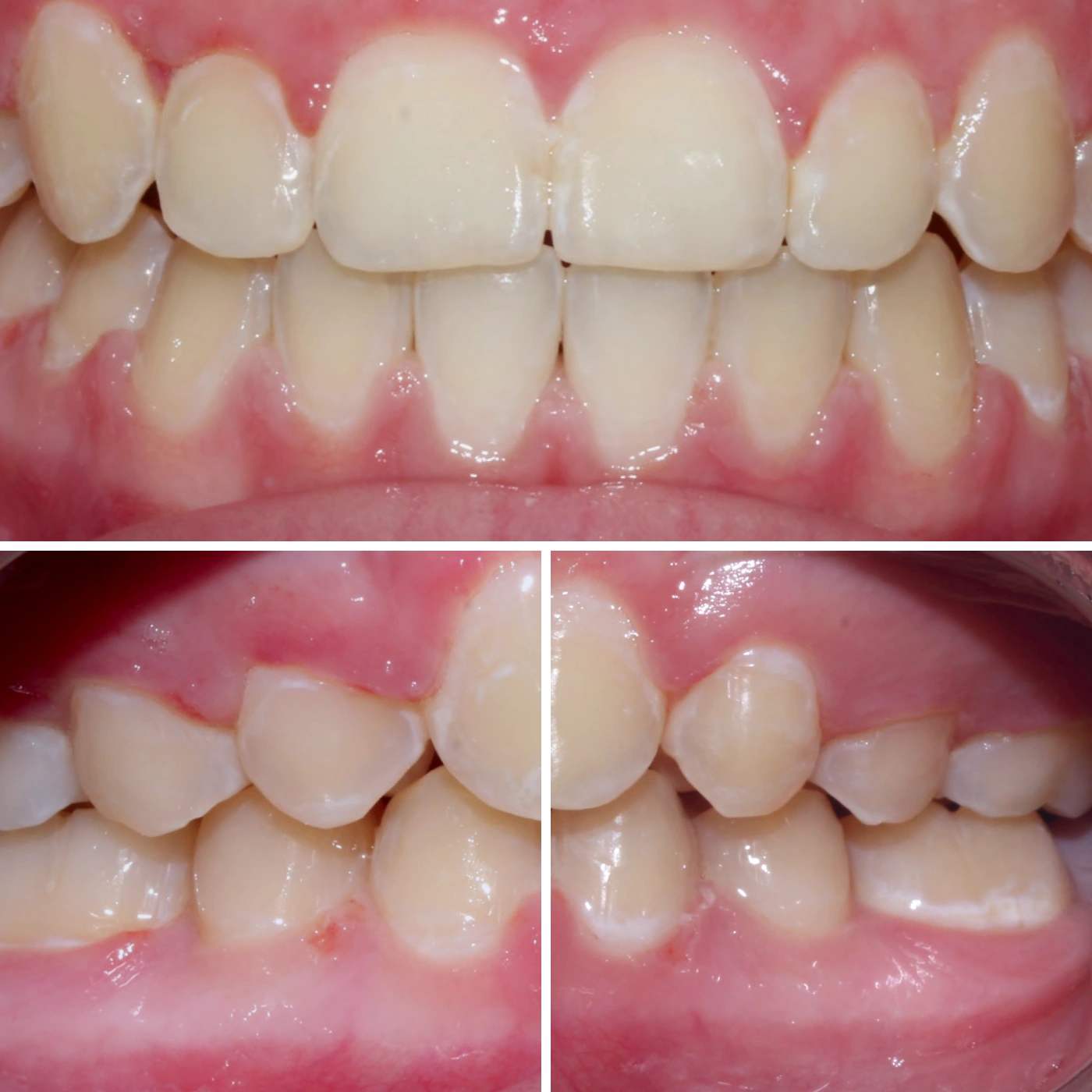 After orthodontic treatment, Smile Gallery case 14