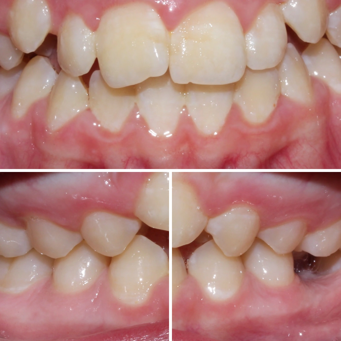 Before orthodontic treatment, Smile Gallery case 14